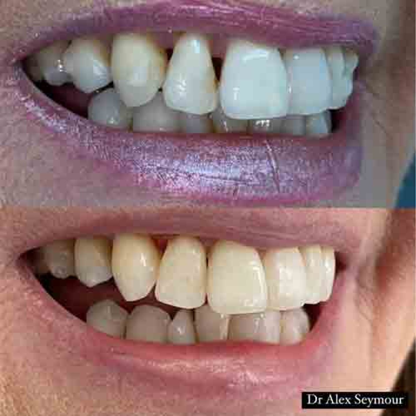 Composite Bonding Gallery Composite Bonding Gallery